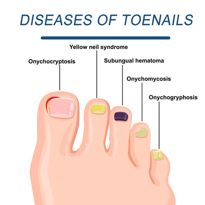 Hand And Foot Nail Care Solution